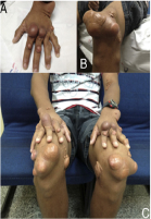 Klinische Aufnahmen, die mehrere Xanthome an den Händen, Knien und Füßen eines erwachsenen Patienten zeigen.