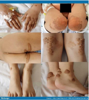 Klinische Aufnahmen, die mehrere Xanthome an den Händen, Ellbogen, Knien und Knöcheln eines pädiatrischen Patienten zeigen.