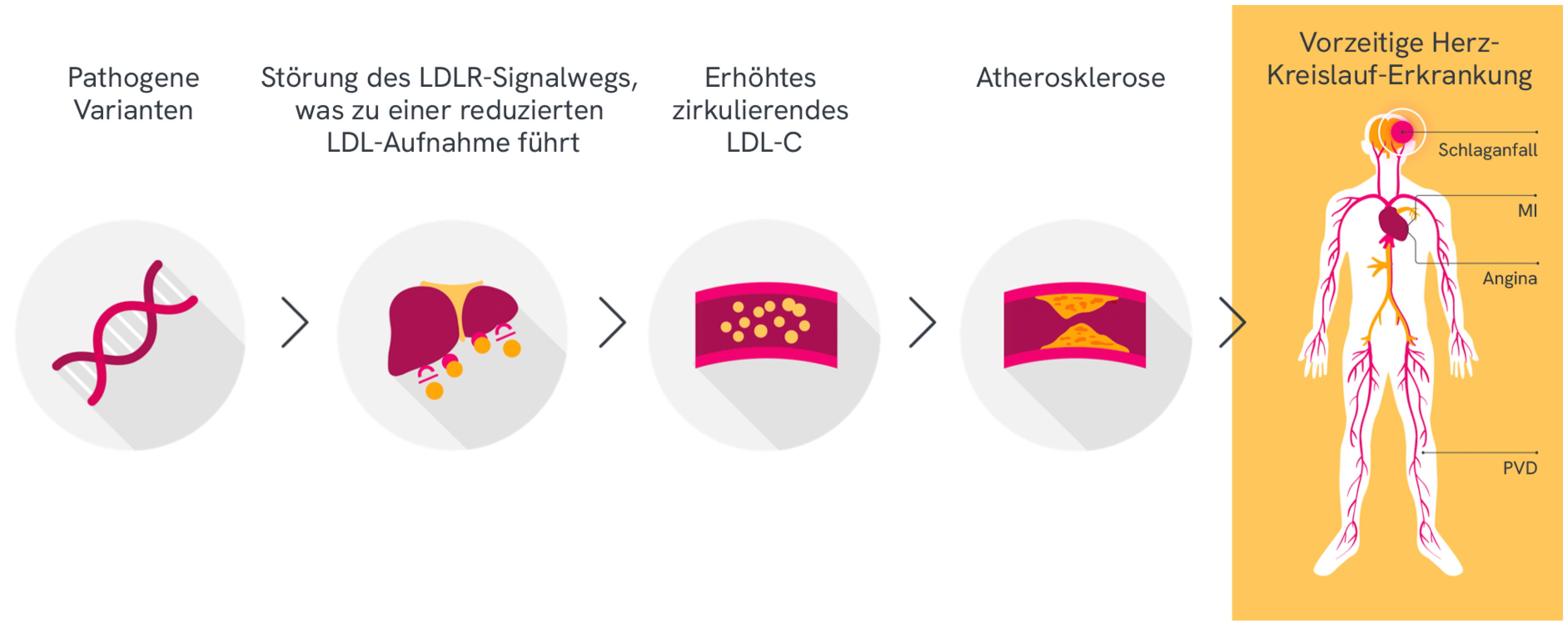 Illustration eines menschlichen Körpers, die die wichtigsten kardiovaskulären Komplikationen zeigt, die mit einer vorzeitigen Herz-Kreislauf-Erkrankung bei HoFH verbunden sind. Beschriftungen weisen auf Schlaganfall im Gehirn, Myokardinfarkt (MI) und Angina pectoris im Herzen sowie periphere Gefässerkrankung (PVD) in den Beinen hin.