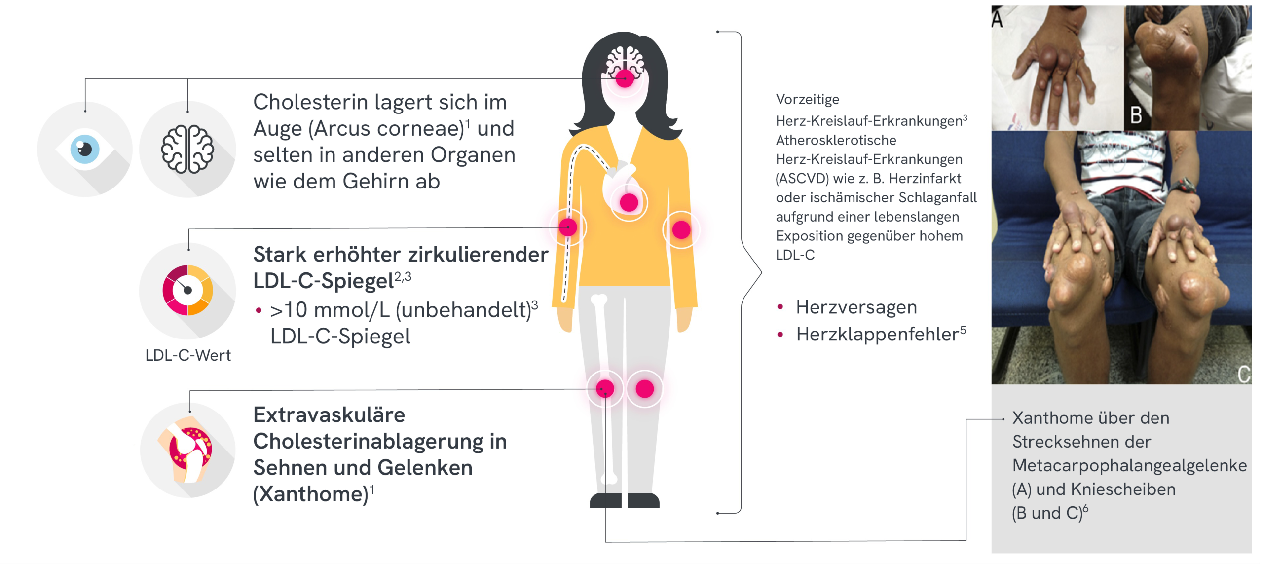 Klinische Aufnahmen, die mehrere Xanthome an den Händen, Knien und Füssen eines erwachsenen Patienten zeigen.