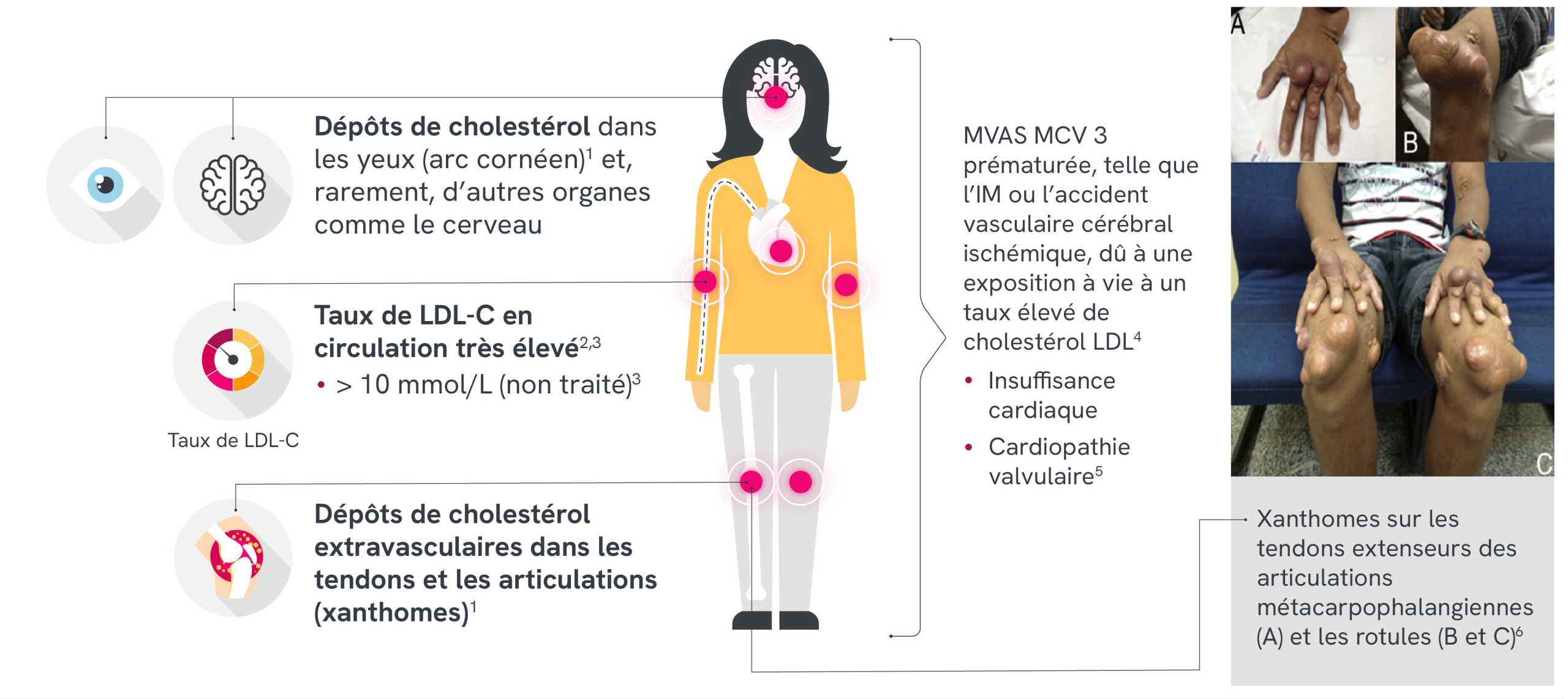 Photographies cliniques montrant de multiples xanthomes sur les mains, les genoux et les pieds d’un patient adulte.