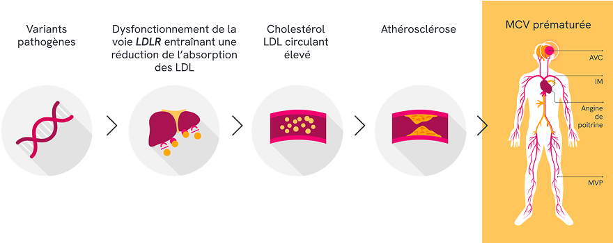 Illustration d’un corps humain montrant les principales complications cardiovasculaires associées à la maladie cardiovasculaire prématurée dans l’HFHo. Des libellés indiquent l’accident vasculaire cérébral dans le cerveau, l’infarctus du myocarde (IM) et l’angine de poitrine au niveau du cœur, ainsi que la maladie vasculaire périphérique (MVP) dans les jambes.